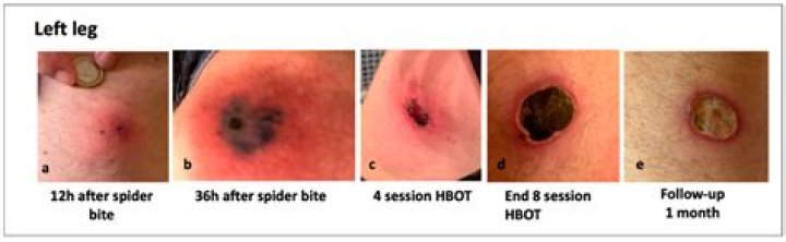 Visual Progression Guide: Identifying Brown Recluse Spider Bite Stages Through Real Lesions