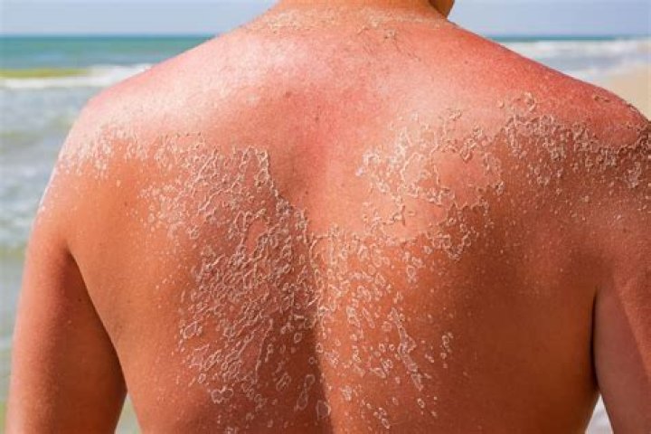 Your Skin Is Peeling After Sunburn: Safe Treatments and What to Avoid